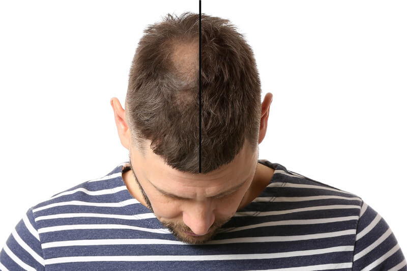 Stem-Cell-Hair-Growth